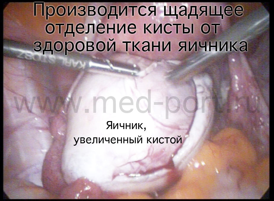 Производится щадящее отделение кисты от здоровой ткани яичника