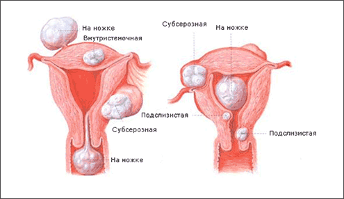 Лапароскопия миомы матки