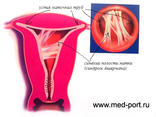 Синехии матки и маточных труб лечение, синдром Ашермана лечение