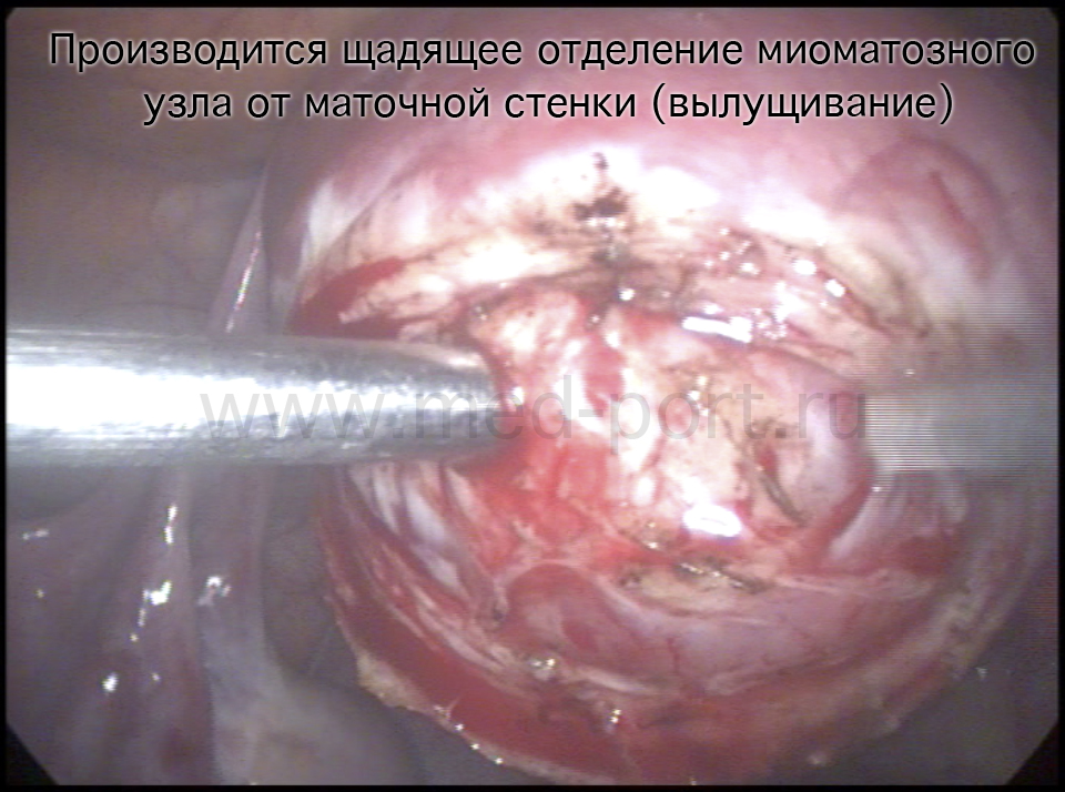 Производится щадящее отделение миоматозного узла от маточной стенки (вылущивание).